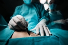 Premiera mondială: O pompă cardiacă inspirată din miscările ondulatorii ale pestilor a fost implantată cu succes in Australia
