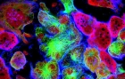 STUDIU STIINTIFIC: De ce apare cancerul și la oamenii cu viață sănătoasă