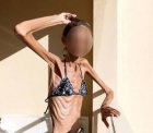 Un important chirurg, impresionat de cazul acestei tinere: "Avea 30 de kilograme si nimeni nu-i mai dadea nicio sansa"