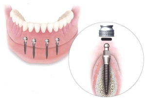Iti lipseste un dinte: implant dentar sau punte dentara?

