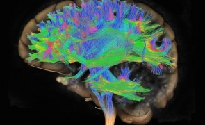 Medicamentul revoluționar împotriva Alzheimer: vindecă cu adevărat boala, nu este doar ameliorator