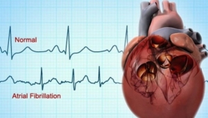 Medicii cardiologi atrag atentia asupra pericolului pe care il reprezinta fibrilatia atrială