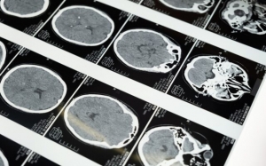 Pas semnificativ în căutarea tratamentelor pentru Parkinson într-o cercetare publicată în Nature și co-semnată de un cercetător român de la Cambridge