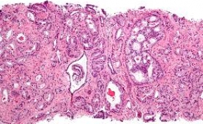 Pas uriaș în lupta cu cancerul - Oamenii de știință au descoperit cum scapă celulele canceroase de acțiunea sistemului imunitar