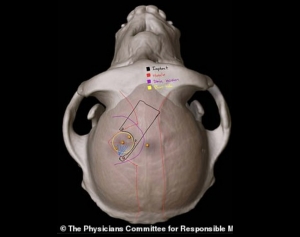 Primul implant cerebral pentru tratarea depresiei: O