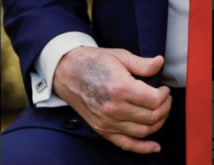 Speculațiile despre sănătatea lui Trump sunt la cote maxime: Experții au dat verdictul real