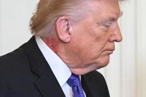 Trump stârneşte noi îngrijorări privind starea sa de sănătate: O eczemă neplăcută a fost observată pe gâtul său
