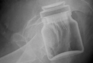 Un bărbat ajuns la spital cu un borcan în anus, în Botoşani: