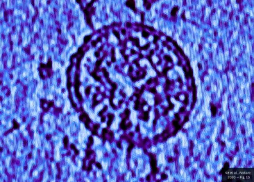 The Lancet: Proteina Spike a COVID-19 produce singură puține reacții acute la oameni. Ele cresc la 95% doar după adăugarea altor componente ale vaccinului