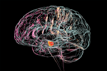 Tratament revoluționar al bolii Parkinson: implantarea în creier a milioane de celule crescute în laborator

