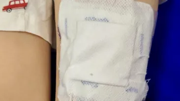 Un băiat de 6 ani din Botoșani a ajuns în comă la spital după ce sora lui de 10 ani i-a pus patru plasturi cu Fentanyl pe o zgârietură. Medic: "Depozitați opioidele sub cheie!"