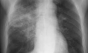 Încă o țară europeană raportează pneumonia misterioasă virală din China

