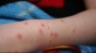 9.700 de cazuri de rujeolă confirmate în România de la debutul epidemiei