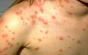 Aproape 90 de cazuri noi de rujeolă, confirmate într-o săptămână; 38 de persoane au murit din cauza bolii de la debutul epidemiei