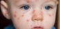 Atentie, parinti! Alerta medicala in vestul tarii! Epidemie de rujeola. Trei copii au murit in Timis si Arad