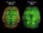 Descoperire revolutionara in Alzheimer care inverseaza boala in doar 6 luni