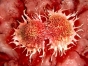 Forma de cancer ce poate fi anuntata de febra, oboseala sau scadere inexplicabila in greutate