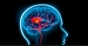 Semne care pot anunta un accident vascular cerebral