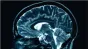 Surpriza factorului declanşator al bolii Alzheimer oferă și o modalitate de a-l neutraliza