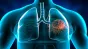 Un nou tratament experimental a prelungit supravieţuirea pacienţilor cu o formă avansată de cancer pulmonar
