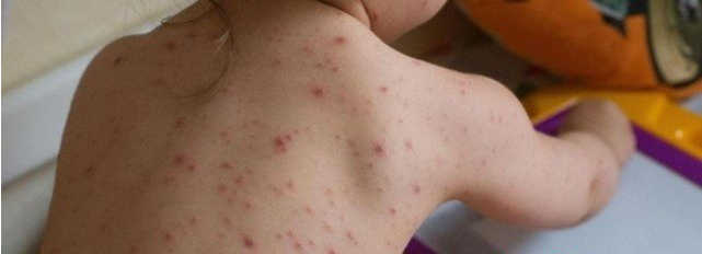 Copil de doi ani nevaccinat. Al 25-lea caz de deces din cauza rujeolei în România!