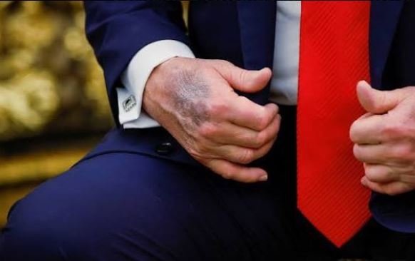 Cum explică Trump vânătăile care îi tot apar pe mâini. „Vreau ca prin inima mea să curgă sânge frumos, subţire"
