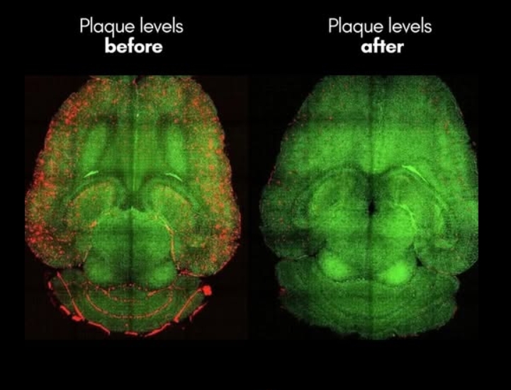 Descoperire revolutionara in Alzheimer care inverseaza boala in doar 6 luni