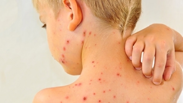 Epidemie de rujeola la copii. Inca 700 de cazuri au fost depistate din cauza nevaccinarii in ultima saptamana