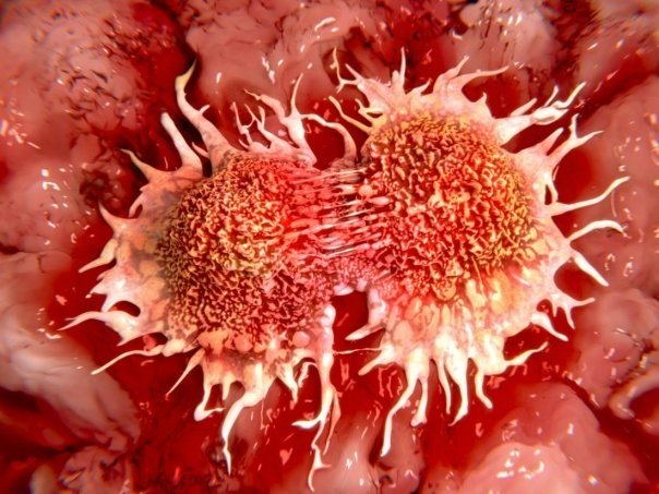 Forma de cancer ce poate fi anuntata de febra, oboseala sau scadere inexplicabila in greutate
