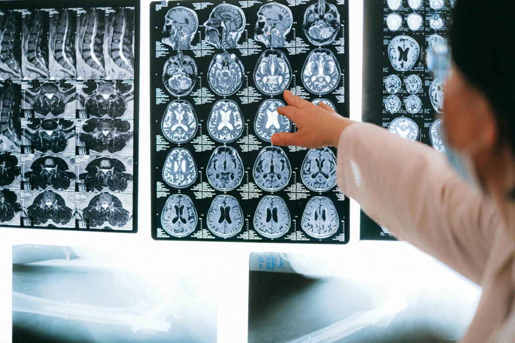 O pandemie de Alzheimer: Boala s-ar putea transmite ca un patogen în anumite cazuri. "Este important să investigăm toate riscurile potențiale"