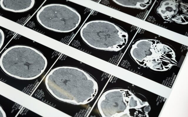 Pas semnificativ în căutarea tratamentelor pentru Parkinson într-o cercetare publicată în Nature și co-semnată de un cercetător român de la Cambridge
