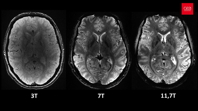 Un magnet de 132 de tone a oferit imagini în premieră ale creierului uman. Va contribui in mod decisiv la depistarea si tratarea Alzheimer si Parkinson