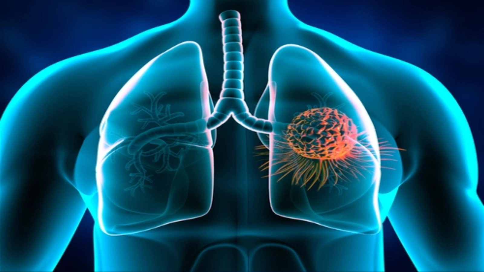 Un nou tratament experimental a prelungit supravieţuirea pacienţilor cu o formă avansată de cancer pulmonar
