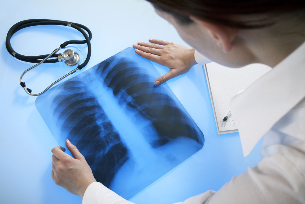 Unui medic a comparat 3 radiografii: Plămânii unei persoane post-COVID sunt mai afectați decât ai unui fumător înrăit!