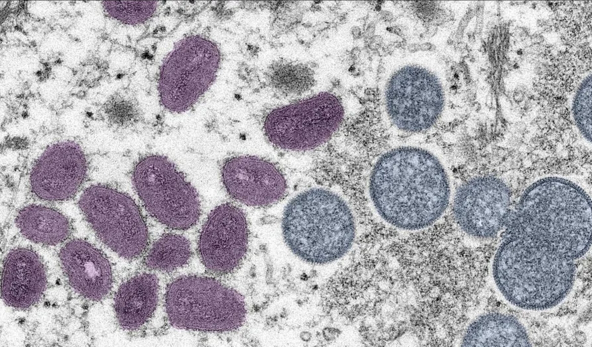Virusul Mpox care a ajuns în Suedia a omorât 548 de oameni în Congo